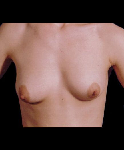 Breast Asymmetry Before