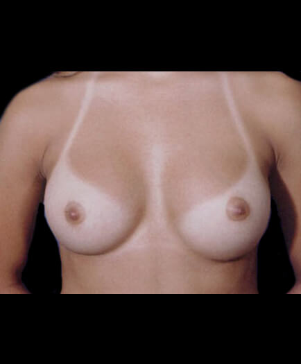 Breast Augmentation After