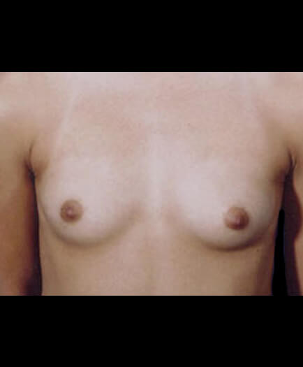 Breast Augmentation Before