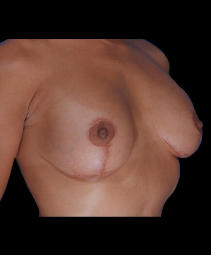 After Breast Lift