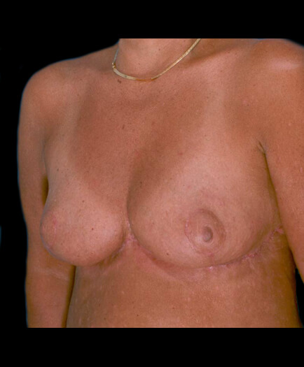 After Breast Reduction