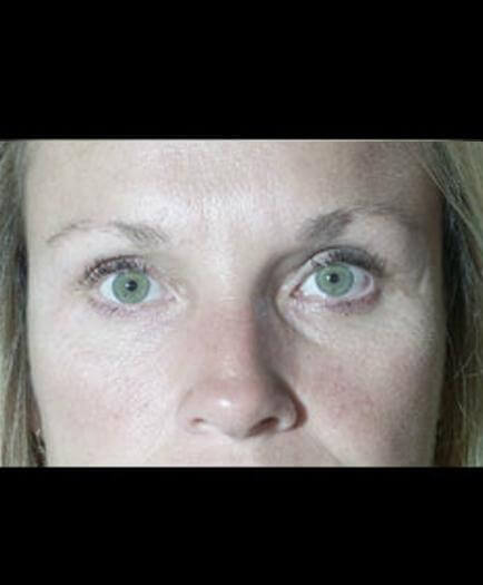 After Eyelid Surgery