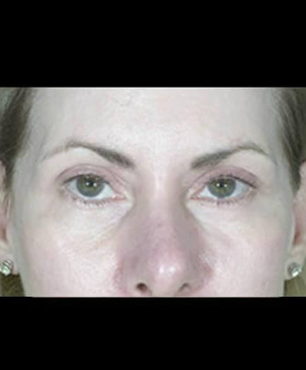 Eyelid Surgery After