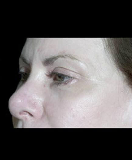 After Blepharoplasty