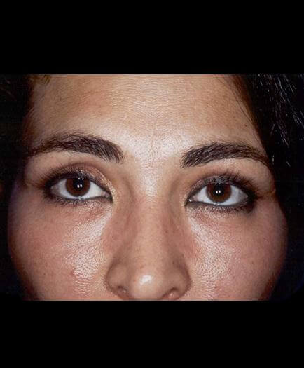 Blepharoplasty Surgery After