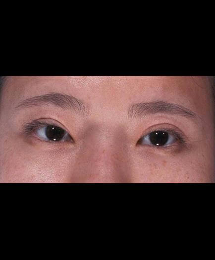 Virginia Eyelid Surgery Results