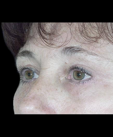 After Blepharoplasty Left Side View