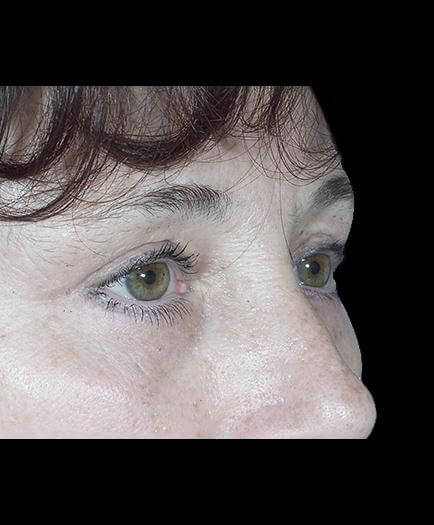 After Blepharoplasty Right Side View