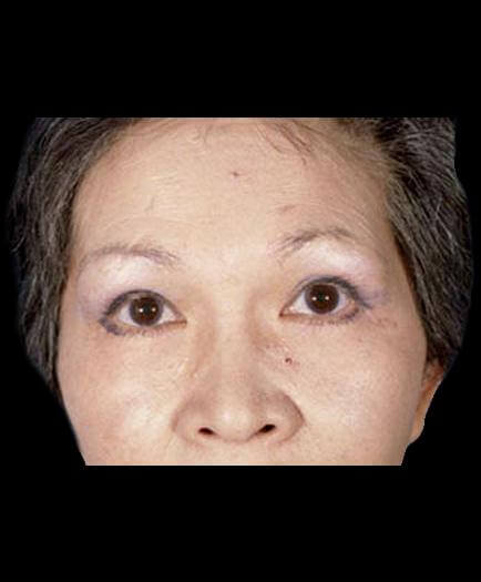 After Virginia Blepharoplasty