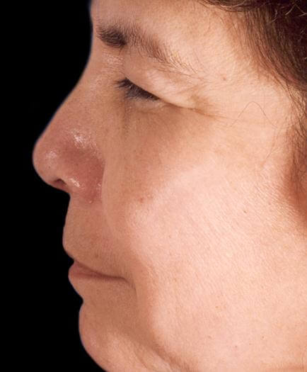 After Rhinoplasty Side View