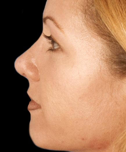 After Rhinoplasty Surgery Side View