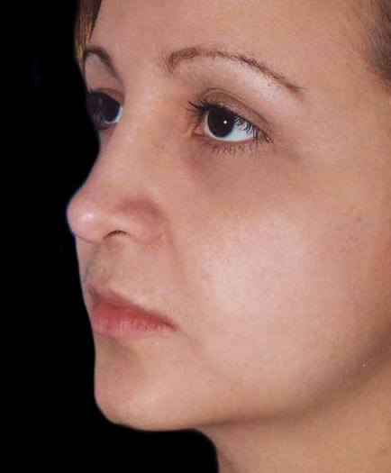 Rhinoplasty After