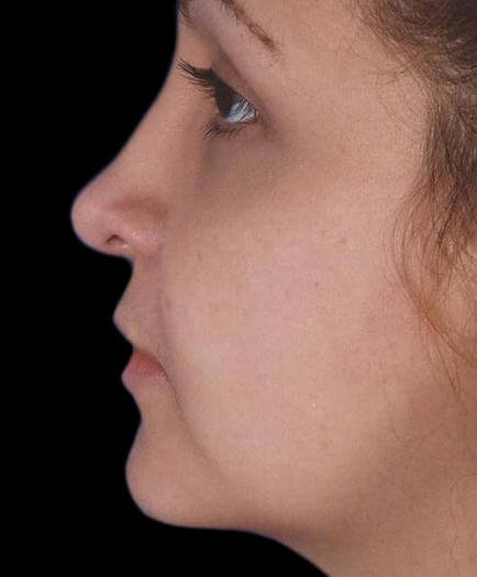 After Nose Surgery Side View