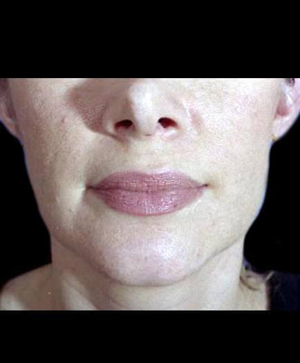 Lip Augmentation After