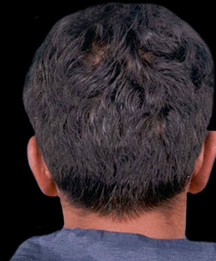 After Male Cosmetic Facial Surgery Back View
