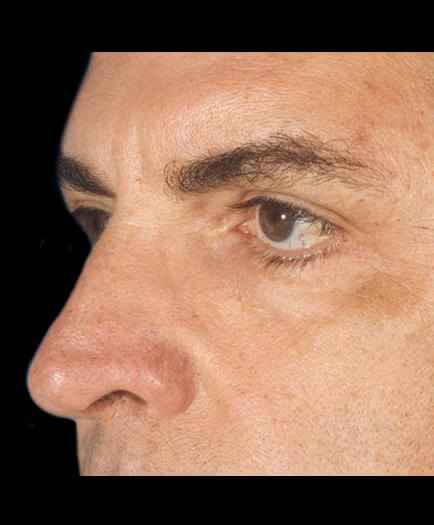 After Male Cosmetic Facial Surgery Side View