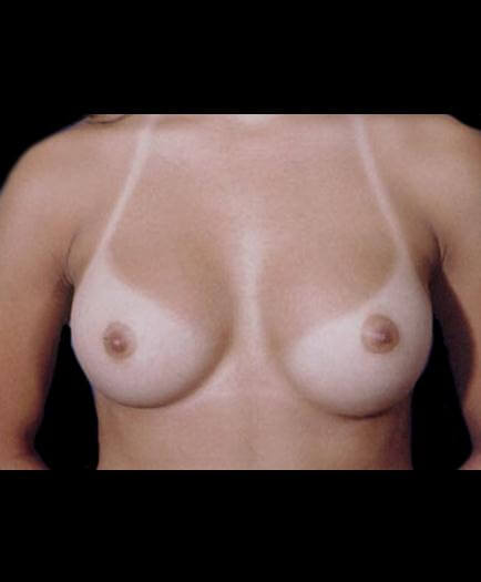 After Breast Augmentation