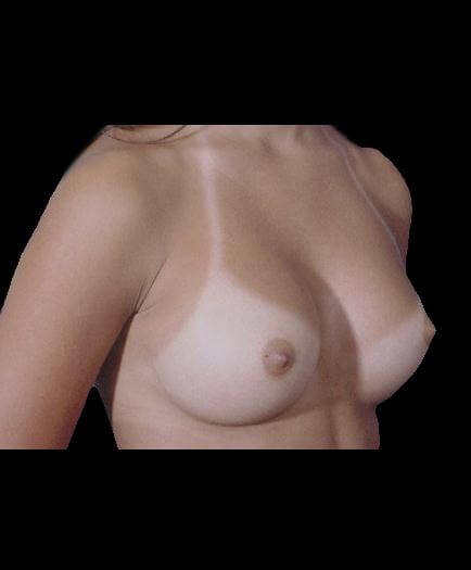 After Breast Augmentation Right Side View
