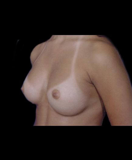 After Breast Augmentation Left Side View