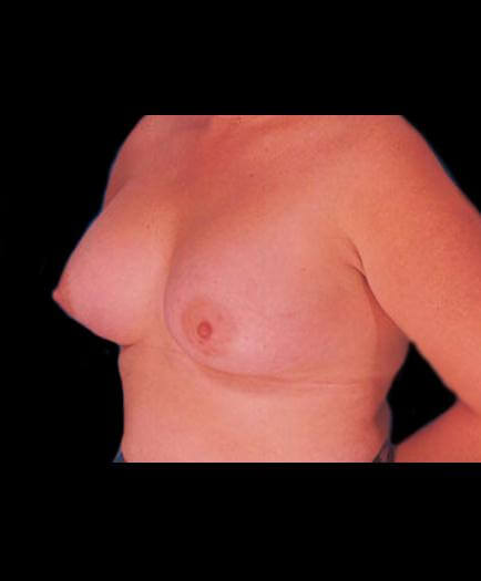 Breast Augmentation After