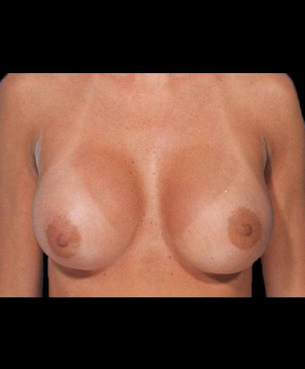 Breast Implants After