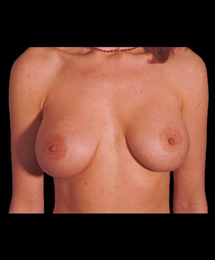 After Virginia Breast Augmentation