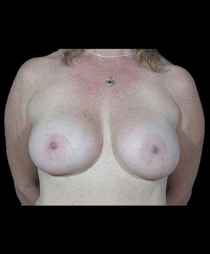 Breast Implant Surgery After