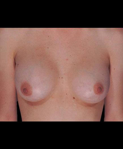 After Virginia Breast Implants