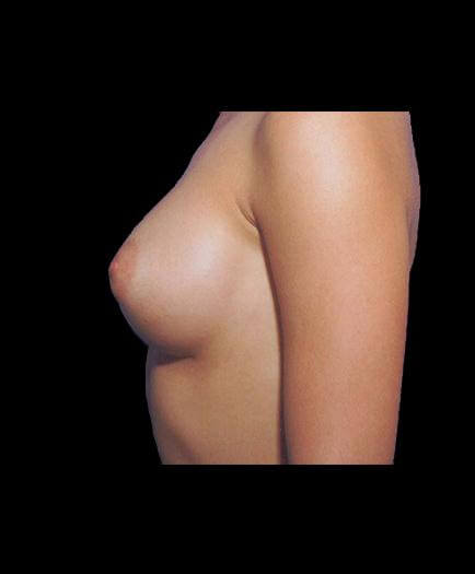 After Breast Implant Surgery Left Side View