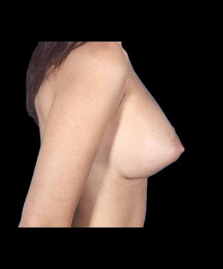 Breast Implant Surgery After Right Side View