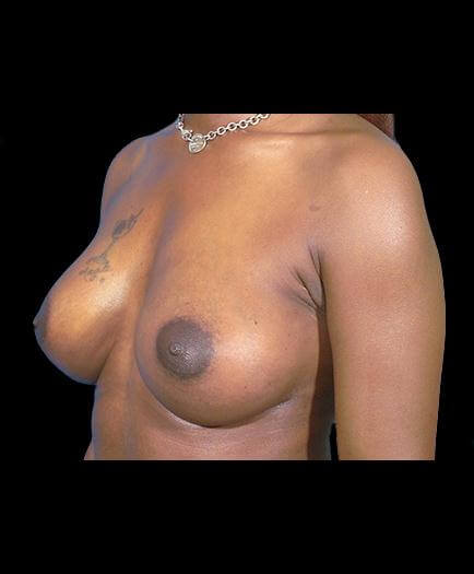 After Breast Augmentation Left Side Image