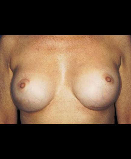Breast Implants After Image
