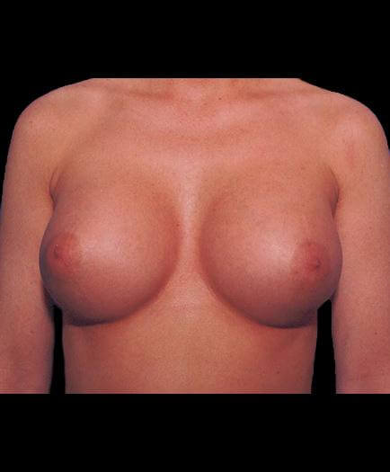 Breast Implant Surgery After Image