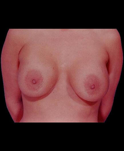 Breast Augmentation After View