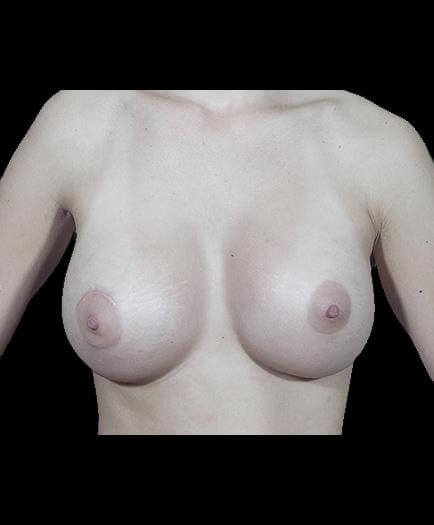 Breast Implant Surgery After View