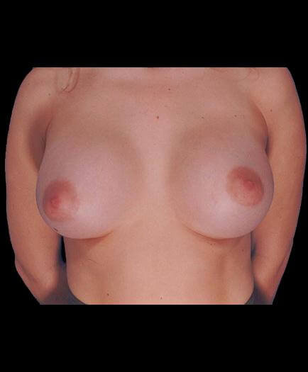 Breast Augmentation After Photo