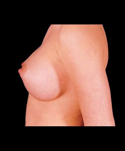 Breast Implants After Photo