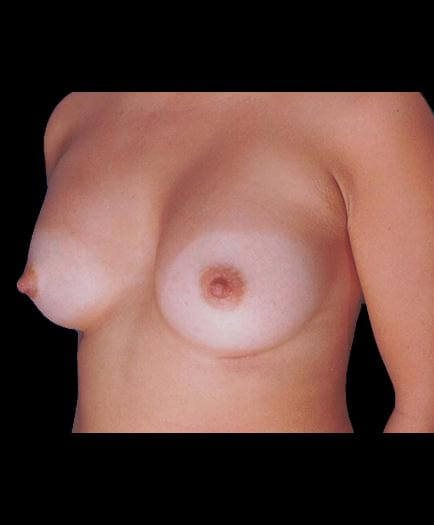 Breast Augmentation Surgery After Photo