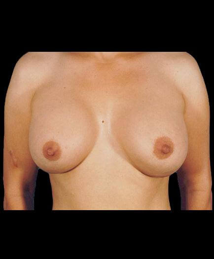 Breast Implant Surgery After Photo