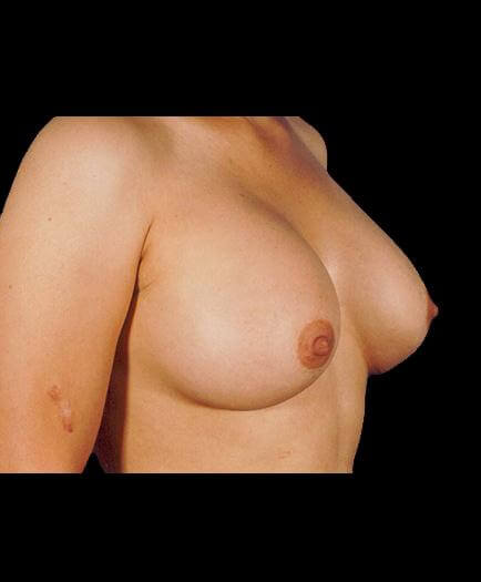 Breast Implant Surgery After Right Side Photo
