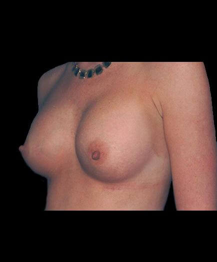 Breast Implants After Picture