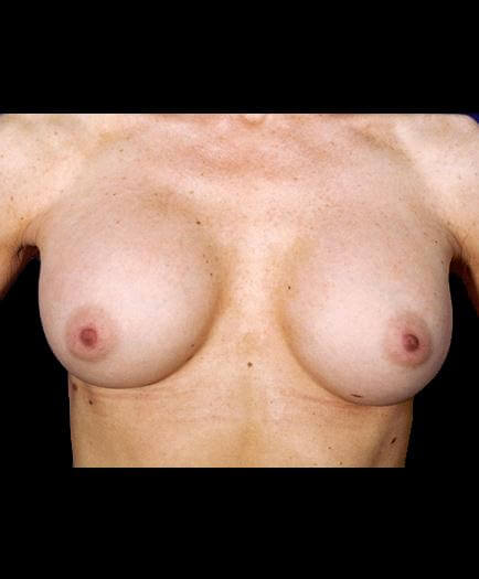 Breast Augmentation Surgery After Picture