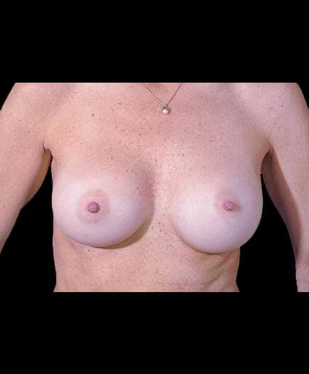 Breast Implant Surgery After Picture