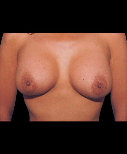 After Breast Implants View