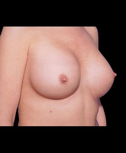 After Breast Augmentation Surgery View