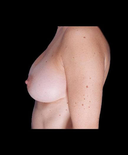 After Breast Augmentation Photo