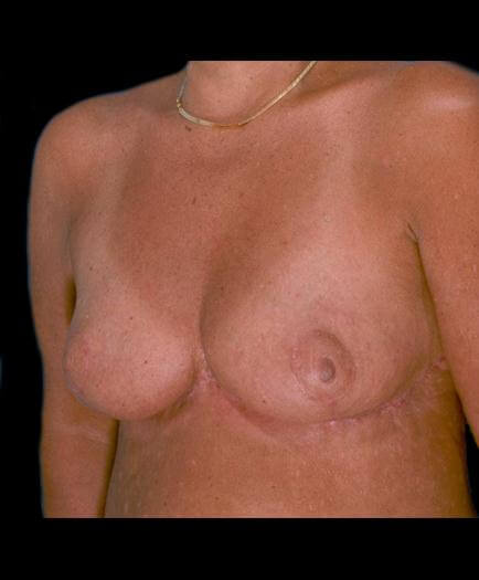 After Breast Reduction