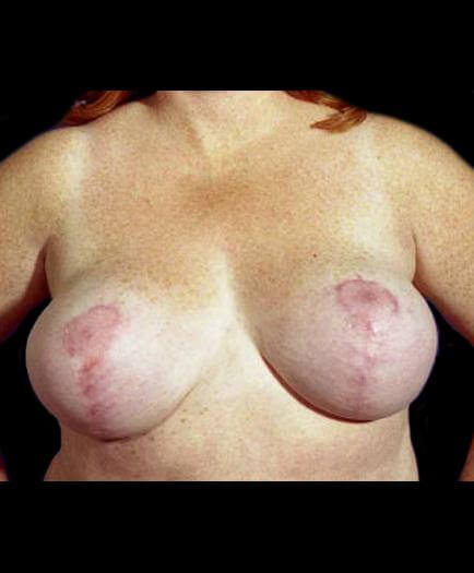 After Breast Reduction Front Image