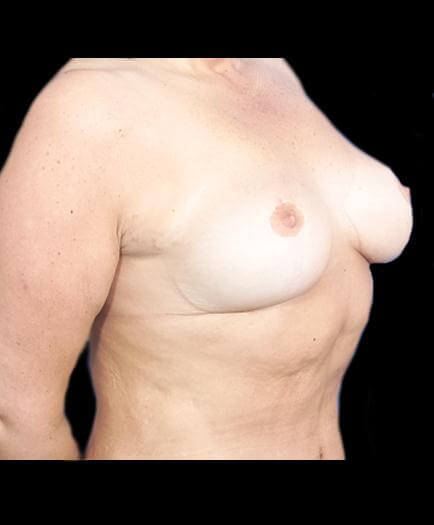 Breast Reduction After Photo