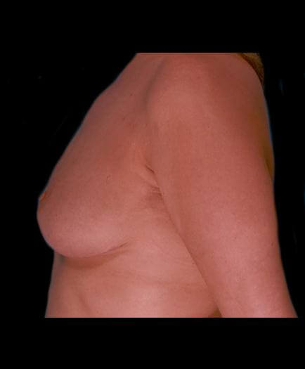 Reduction Mammoplasty Surgery After Photo